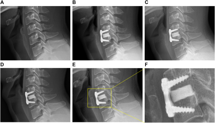 Anterior Cervical Discectomy Fusion — FIGURE 3