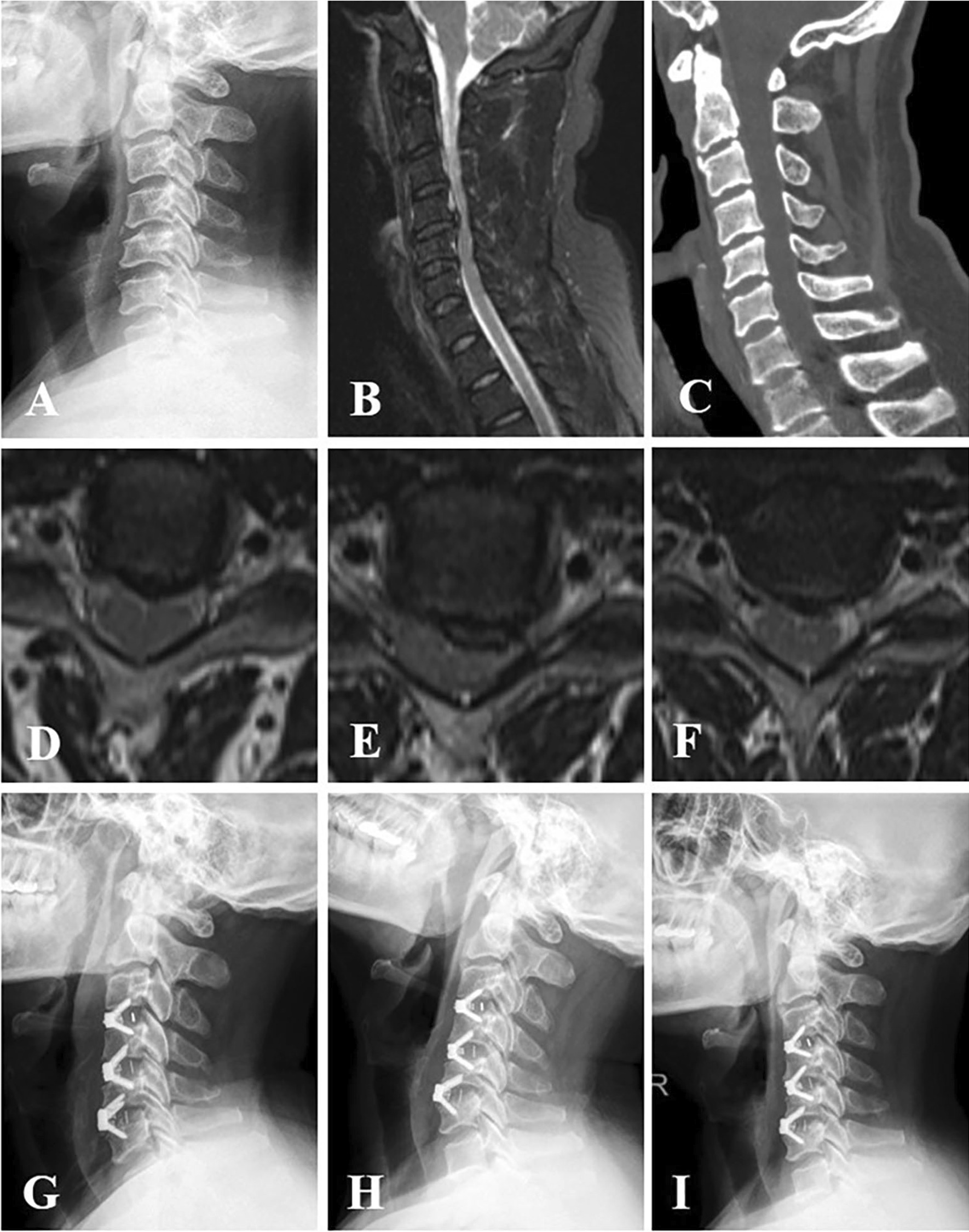 Anterior Cervical Discectomy Fusion — Fig. 1