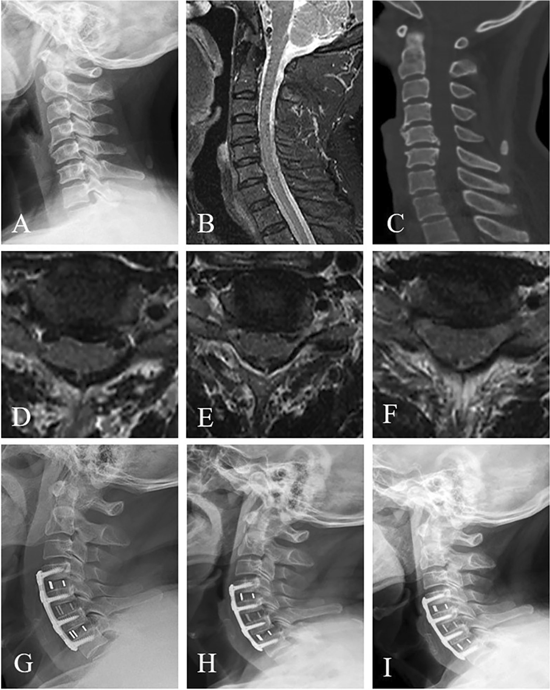 Anterior Cervical Discectomy Fusion — Fig. 2
