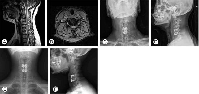Anterior Cervical Discectomy Fusion — Fig. 1