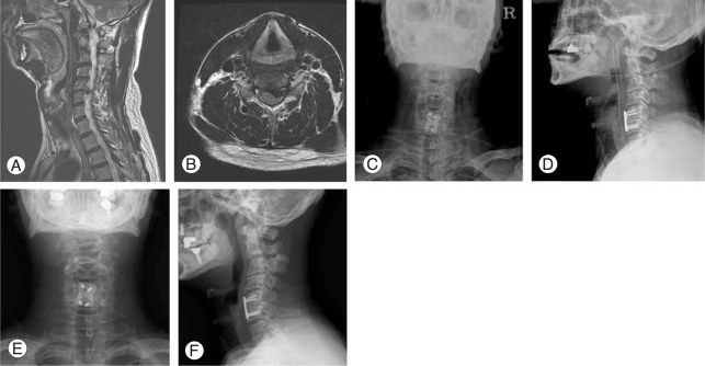 Anterior Cervical Discectomy Fusion — Fig. 2