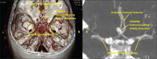 Anterior Communicating Artery Aneurysm Clipping — Figure 1