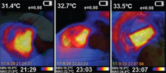 Anterior Communicating Artery Aneurysm Clipping — Figure 2