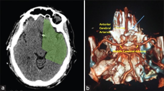 Anterior Communicating Artery Aneurysm Clipping — Figure 3