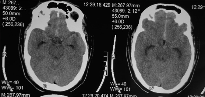 Anterior Communicating Artery Aneurysm Clipping — Figure 1: