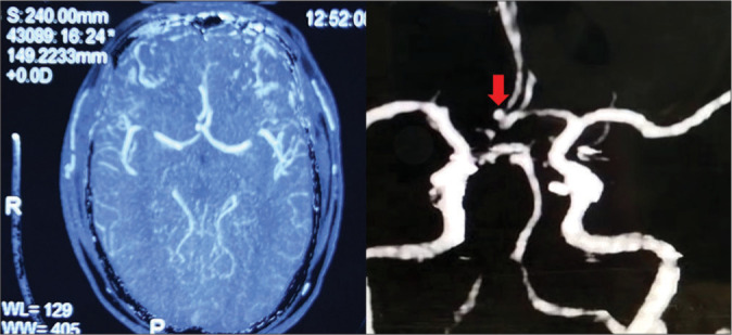 Anterior Communicating Artery Aneurysm Clipping — Figure 2: