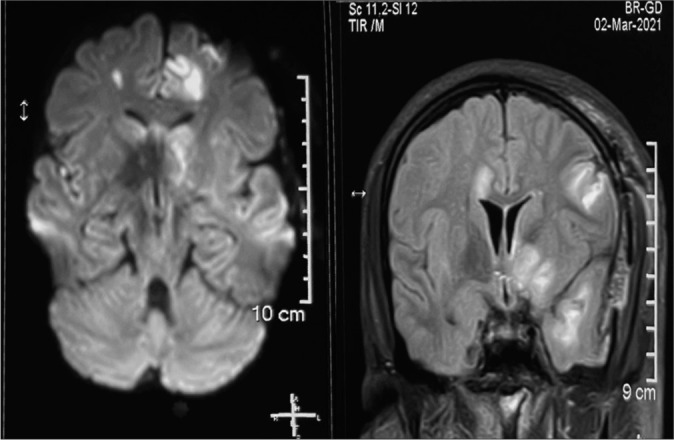 Anterior Communicating Artery Aneurysm Clipping — Figure 3: