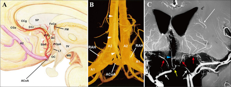 Anterior Communicating Artery Aneurysm Clipping — Figure 1: