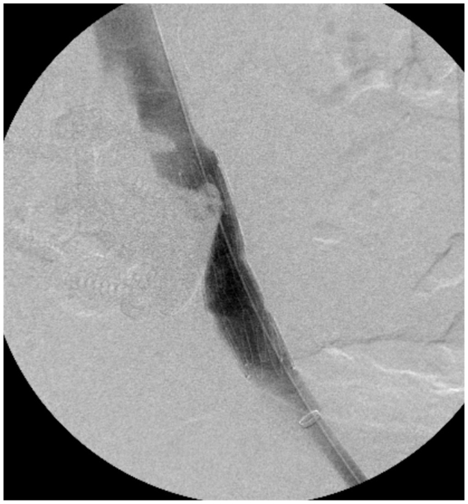 Anterior Lumbar Interbody Fusion — Fig 1