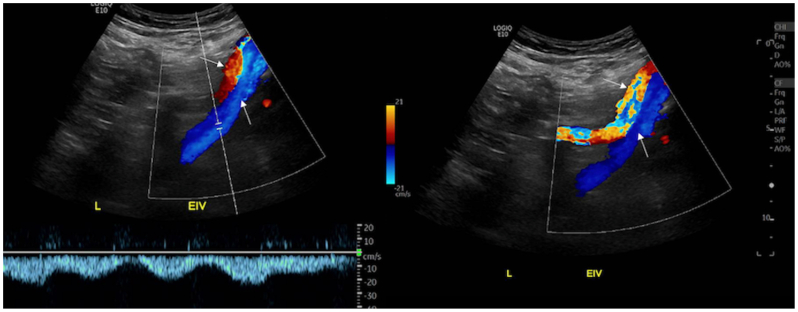 Anterior Lumbar Interbody Fusion — Fig 2
