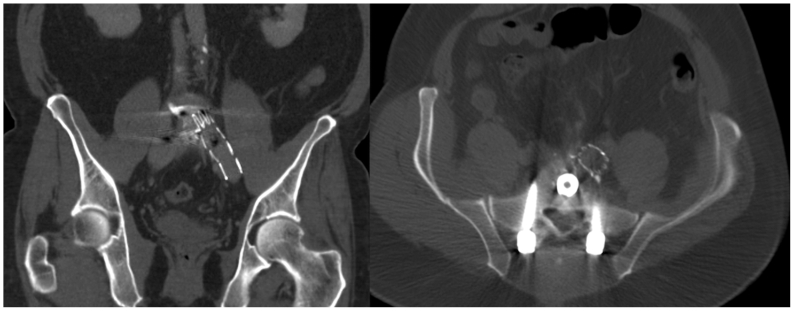 Anterior Lumbar Interbody Fusion — Fig 3
