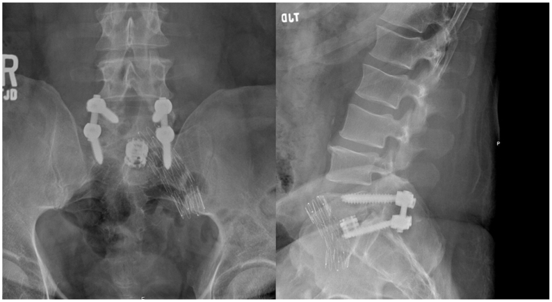 Anterior Lumbar Interbody Fusion — Fig 4
