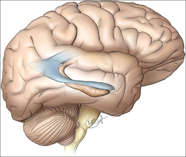 Anterior Temporal Lobectomy Selective Amygdalohippocampectomy — Figure 1
