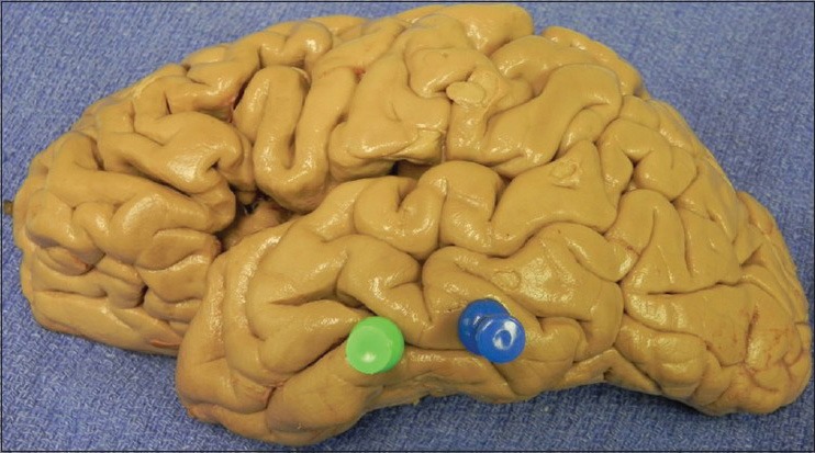 Anterior Temporal Lobectomy Selective Amygdalohippocampectomy — Figure 2