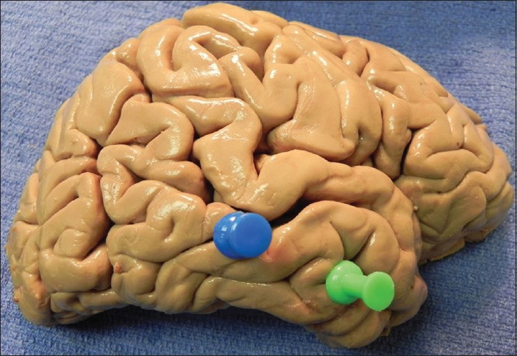 Anterior Temporal Lobectomy Selective Amygdalohippocampectomy — Figure 3