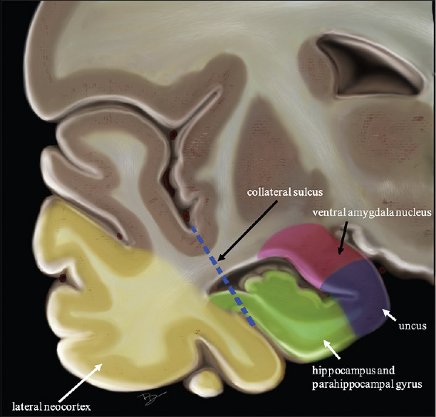 Anterior Temporal Lobectomy Selective Amygdalohippocampectomy — Figure 1