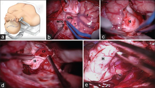 Anterior Temporal Lobectomy Selective Amygdalohippocampectomy — Figure 2