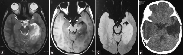 Anterior Temporal Lobectomy Selective Amygdalohippocampectomy — Figure 3