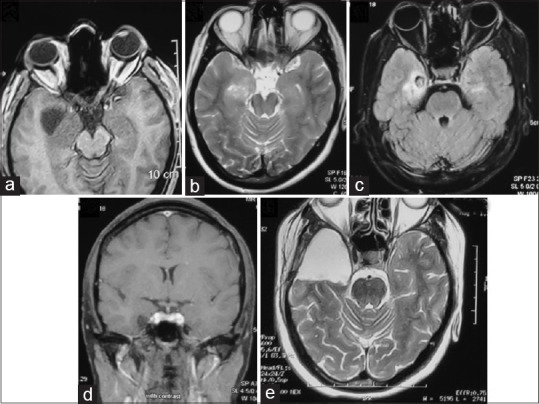 Anterior Temporal Lobectomy Selective Amygdalohippocampectomy — Figure 4