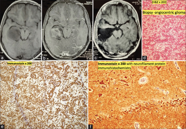 Anterior Temporal Lobectomy Selective Amygdalohippocampectomy — Figure 5