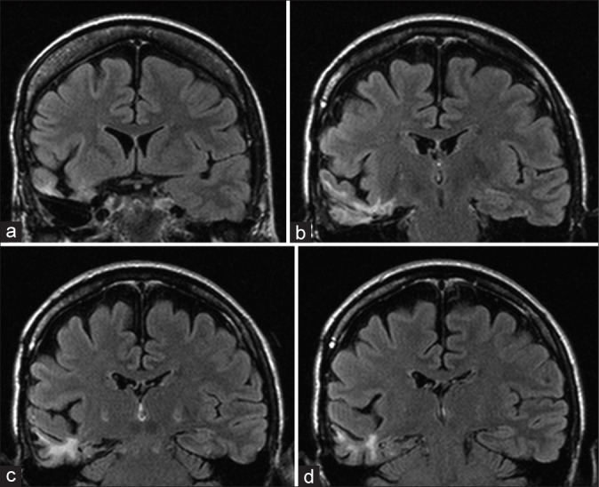 Anterior Temporal Lobectomy Selective Amygdalohippocampectomy — Figure 1: