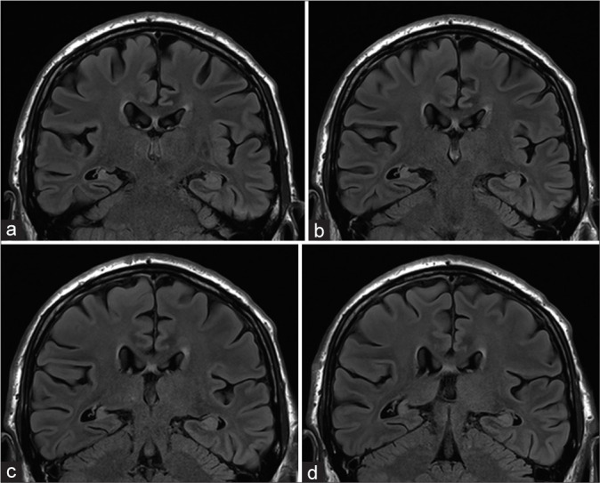 Anterior Temporal Lobectomy Selective Amygdalohippocampectomy — Figure 2: