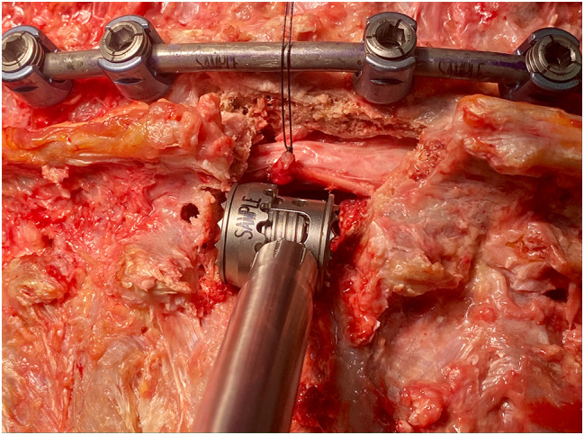 Anterior Thoracic Corpectomy Reconstruction — Fig. 2