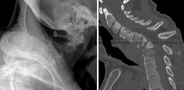 Anterior Thoracic Corpectomy Reconstruction — Fig. 1