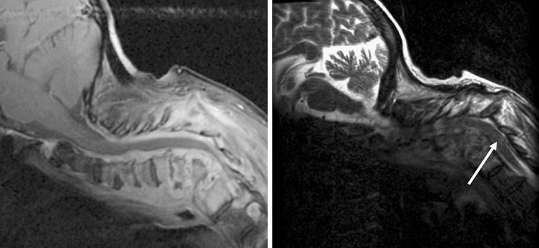 Anterior Thoracic Corpectomy Reconstruction — Fig. 2