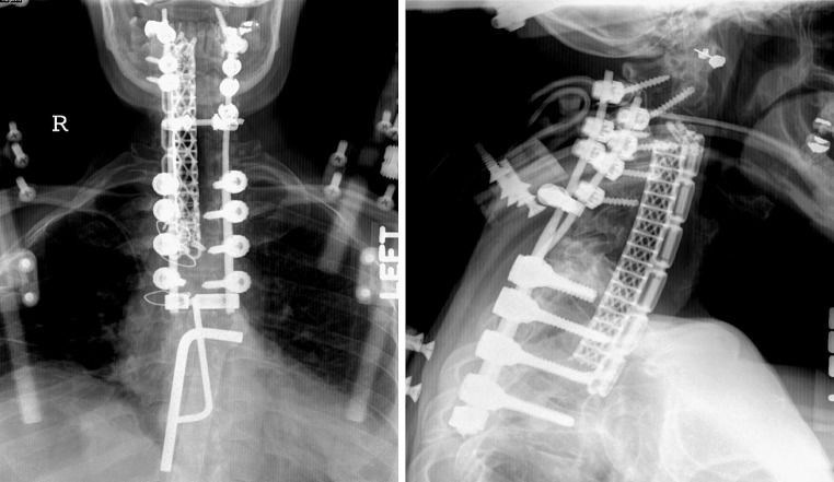 Anterior Thoracic Corpectomy Reconstruction — Fig. 3