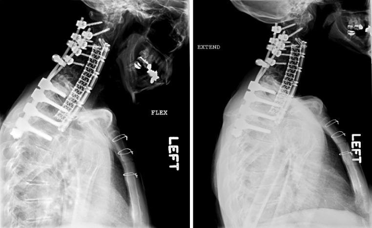 Anterior Thoracic Corpectomy Reconstruction — Fig. 4