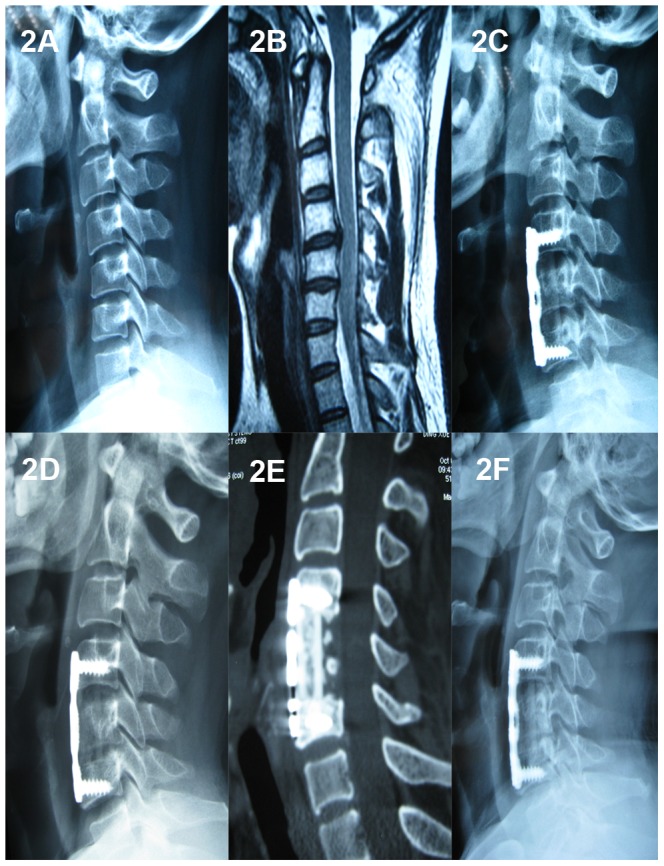 Anterior Thoracic Corpectomy Reconstruction — Figure 2