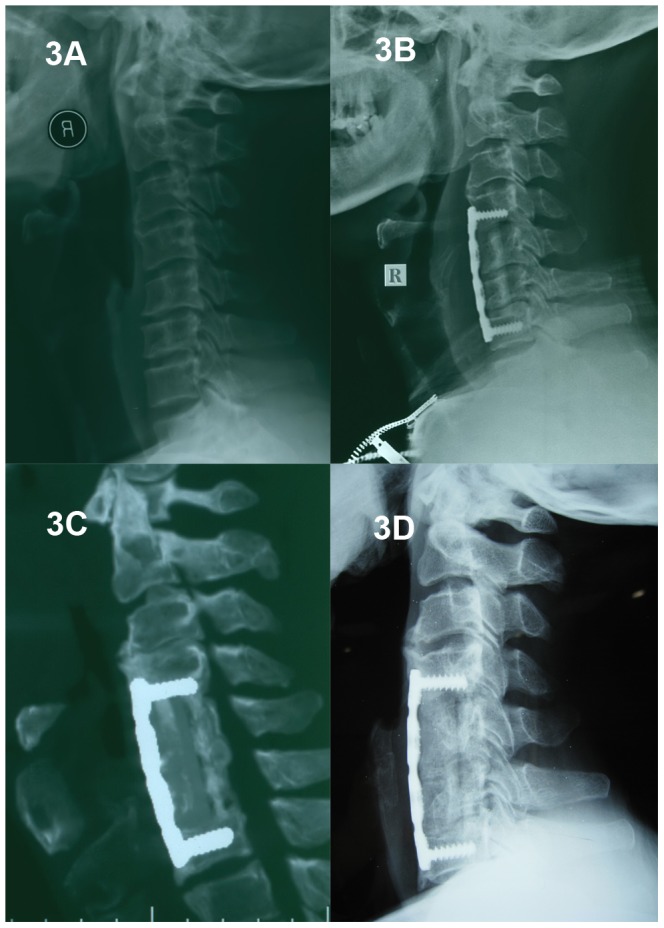 Anterior Thoracic Corpectomy Reconstruction — Figure 3