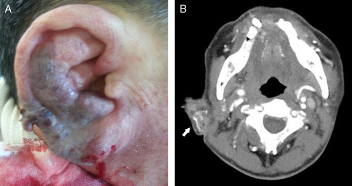 Arteriovenous Malformation Resection — Figure 1