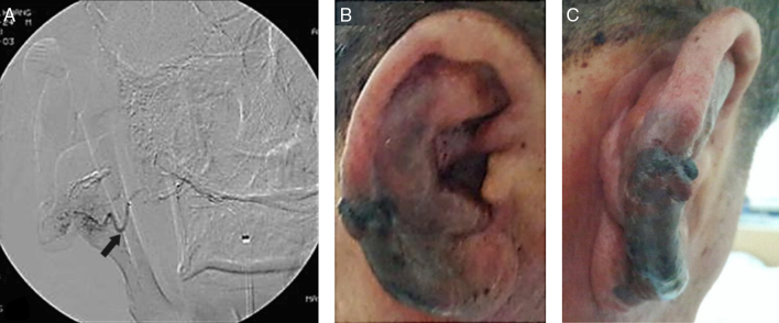 Arteriovenous Malformation Resection — Figure 2