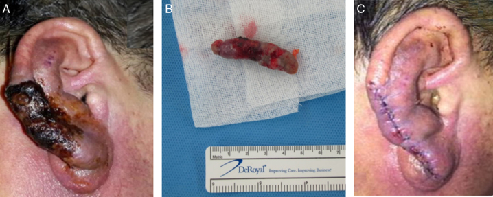 Arteriovenous Malformation Resection — Figure 3