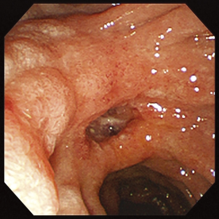 Arteriovenous Malformation Resection — Fig. 1