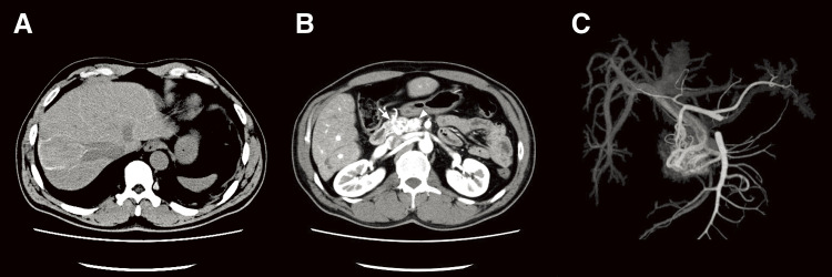 Arteriovenous Malformation Resection — Fig. 2