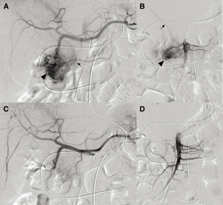 Arteriovenous Malformation Resection — Fig. 3