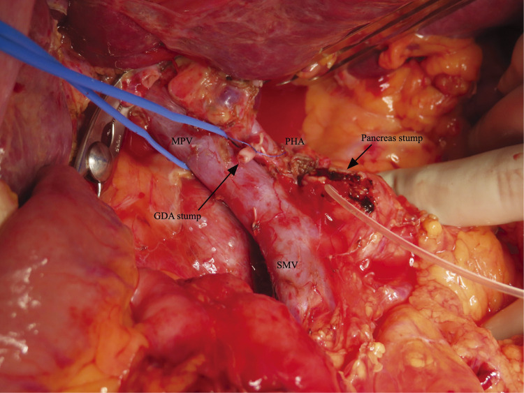 Arteriovenous Malformation Resection — Fig. 4