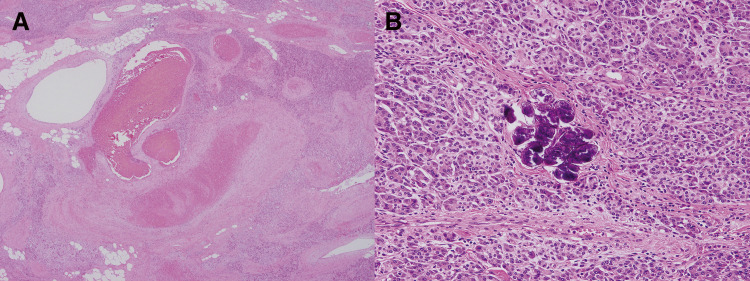 Arteriovenous Malformation Resection — Fig. 5
