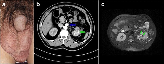 Arteriovenous Malformation Resection — Fig. 1