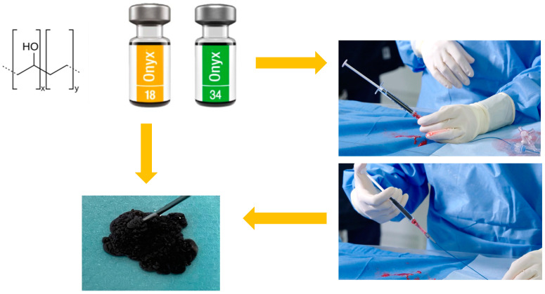 AVM dAVF Endovascular Embolization — Figure 1