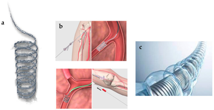 AVM dAVF Endovascular Embolization — Figure 2