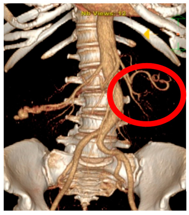 AVM dAVF Endovascular Embolization — Figure A1