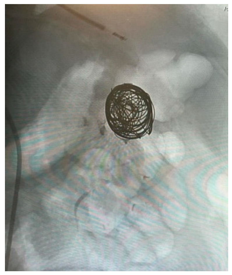 AVM dAVF Endovascular Embolization — Figure A1