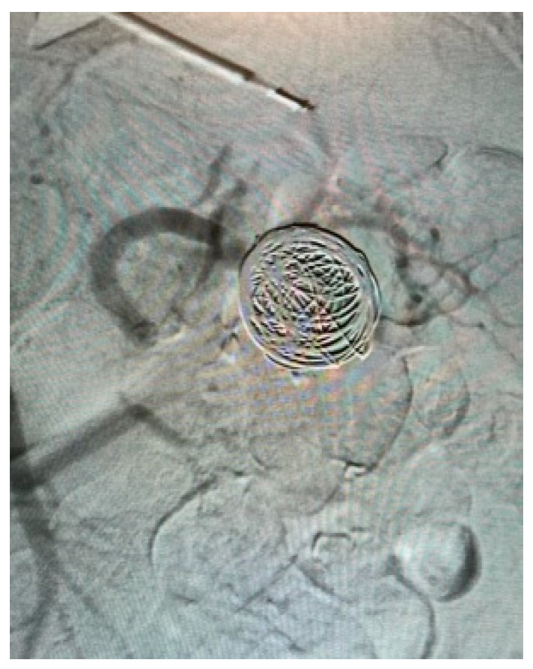 AVM dAVF Endovascular Embolization — Figure A1