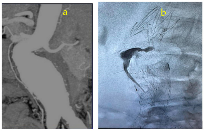 AVM dAVF Endovascular Embolization — Figure A1