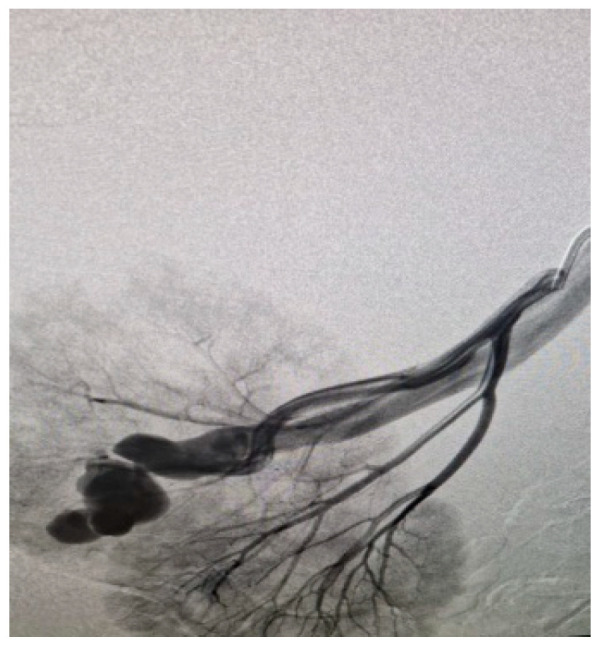 AVM dAVF Endovascular Embolization — Figure A2