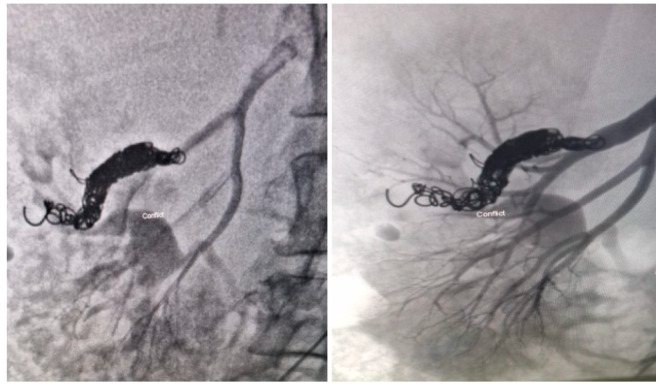 AVM dAVF Endovascular Embolization — Figure A3